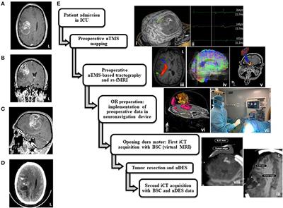 Case Report: Multimodal Functional and Structural Evaluation Combining Pre-operative nTMS Mapping and Neuroimaging With Intraoperative CT-Scan and Brain Shift Correction for Brain Tumor Surgical Resection